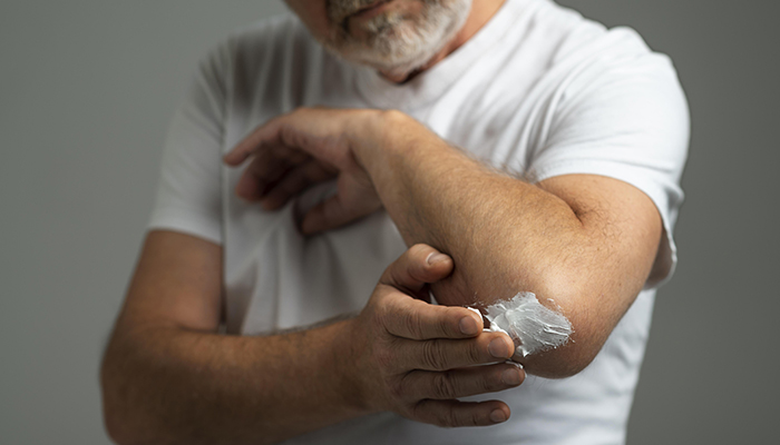 ¿Picaduras de mosquitos o medusas?